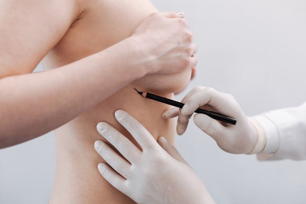 preparation for breast augmentation surgery