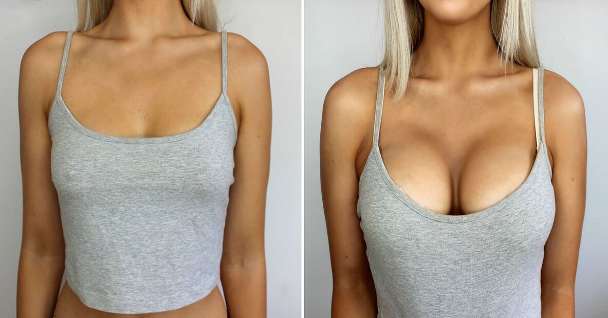 Before and after the increase of the breast