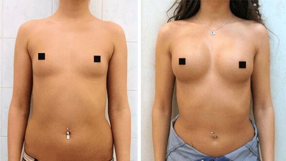 pictures before and after surgical breast augmentation